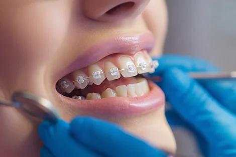Ortodontia com aparelhos estéticos em Sorocaba — OrthoStudio