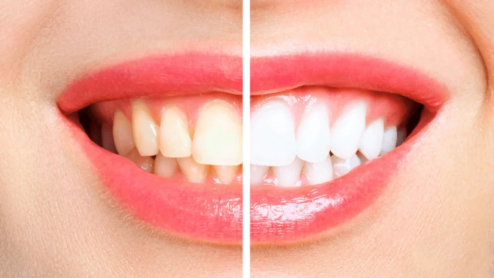 Sorriso com dentes visivelmente mais claros após clareamento dental, tratamento realizado na OrthoStudio em Sorocaba-SP