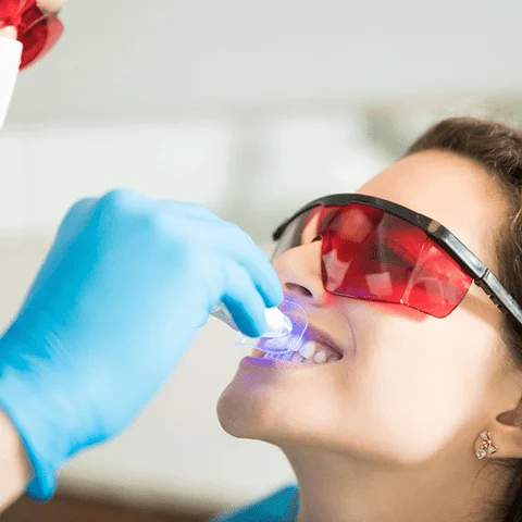Paciente com óculos de proteção recebendo aplicação de gel clareador em consultório, etapa do clareamento combinado na OrthoStudio, Sorocaba-SP